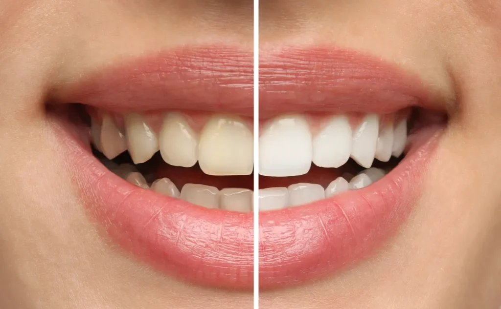 Close-up of a smile showing before and after results of professional tooth whitening treatment performed at Pearl Dental.